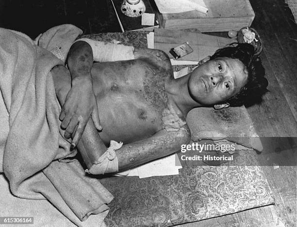 Young man lies on a mat with burns covering his body, after falling victim to the explosion of the atom bomb over Nagasaki, Japan. 1945. | Location:...