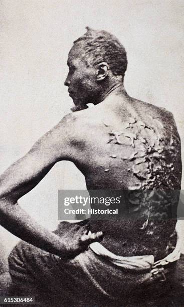 Gordon, also known as "Whipped Peter", a former enslaved man, shows his scarred back at a medical examination, Baton Rouge, Louisiana, 2nd April...