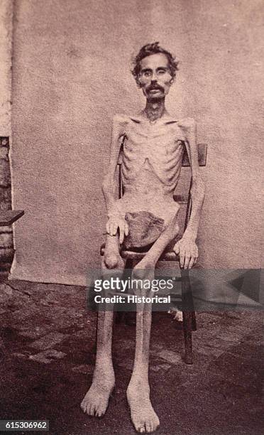 Starved Union prisoner of war, exhibits his condition after his release from a Confederate prison after the end of the American Civil War.