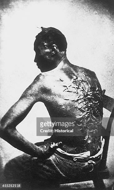 Gordon, also known as "Whipped Peter", a former enslaved man, shows his scarred back at a medical examination, Baton Rouge, Louisiana, 2nd April...