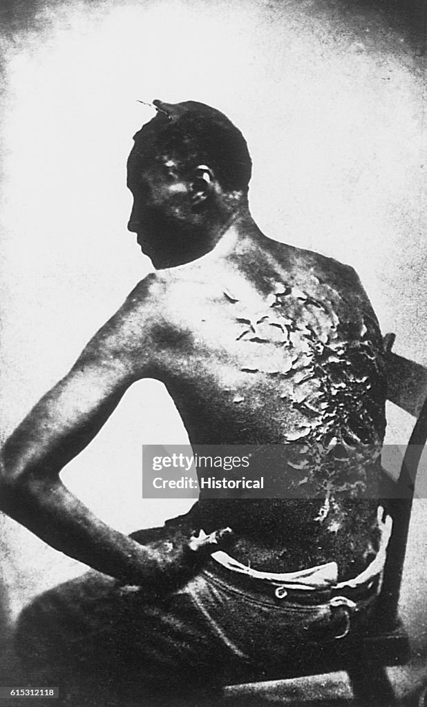 Rear View of Former Enslaved Man Revealing Scars at Medical Inspection