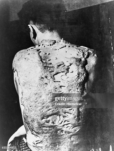 Keloids cover the back of a survivor of the Nagasaki atomic bomb. Keloids are dense, fibrous growths that grow over scar tissue.