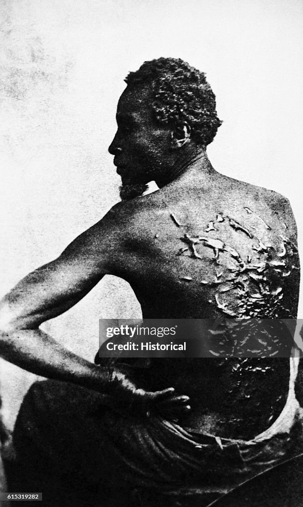 Rear View of Former Enslaved Man Revealing Scars at Medical Inspection