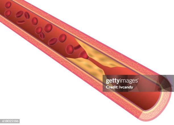 ilustraciones, imágenes clip art, dibujos animados e iconos de stock de arteriosclerosis - vaso sanguíneo