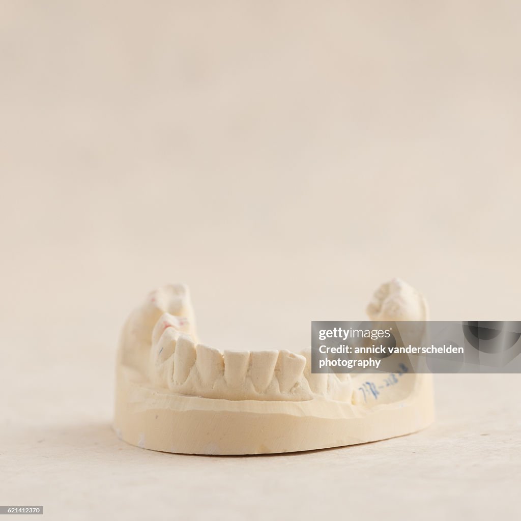 Dental implant. Mould of the jaw.