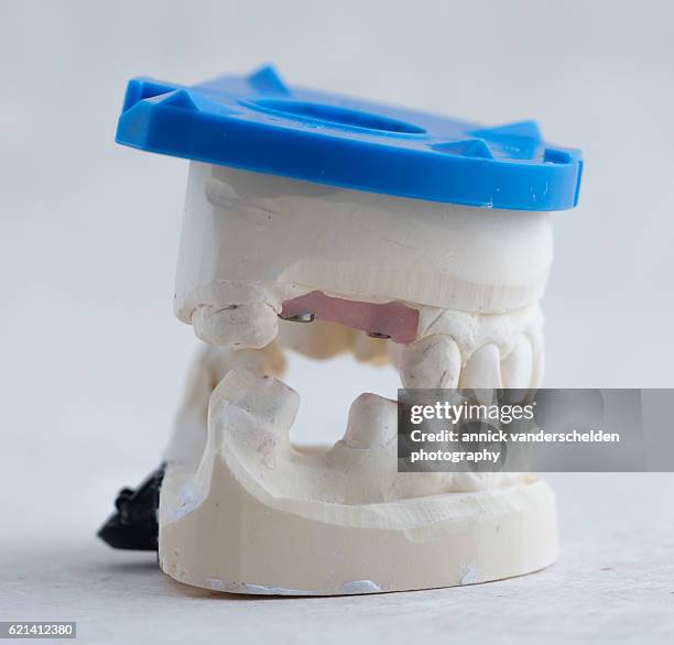 dental implant. mould of the jaw. - dental crown stock pictures, royalty-free photos & images