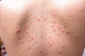 Detail with chicken pox rash at the back of body