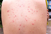 Detail with chicken pox rash at the back of woman