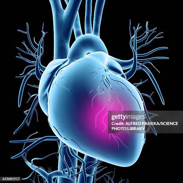 heart attack, conceptual artwork - heart disease stock illustrations