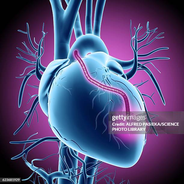 ilustraciones, imágenes clip art, dibujos animados e iconos de stock de heart bypass graft, artwork - miocardio