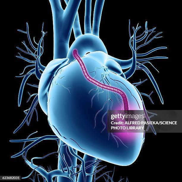 heart bypass graft, artwork - atherosklerose stock-grafiken, -clipart, -cartoons und -symbole