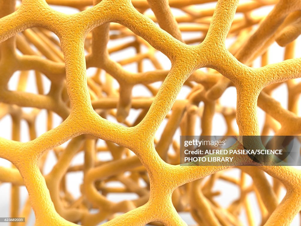 Osteoporotic bone, artwork