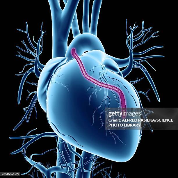ilustraciones, imágenes clip art, dibujos animados e iconos de stock de heart bypass graft, artwork - miocardio