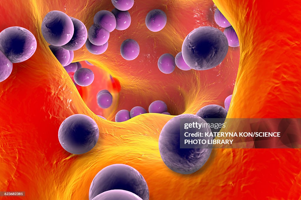 Staphylococcus infection, illustration