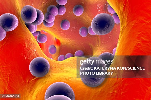 Staphylococcus infection, illustration Staphylococcus infection, illustration