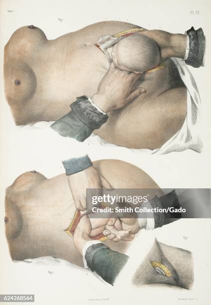 Two illustrations showing two different Caesarean methods, 1900. .