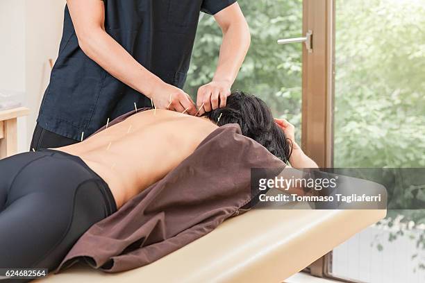 acupuncturist sticking acupuncture needles - agulha de acupuntura imagens e fotografias de stock