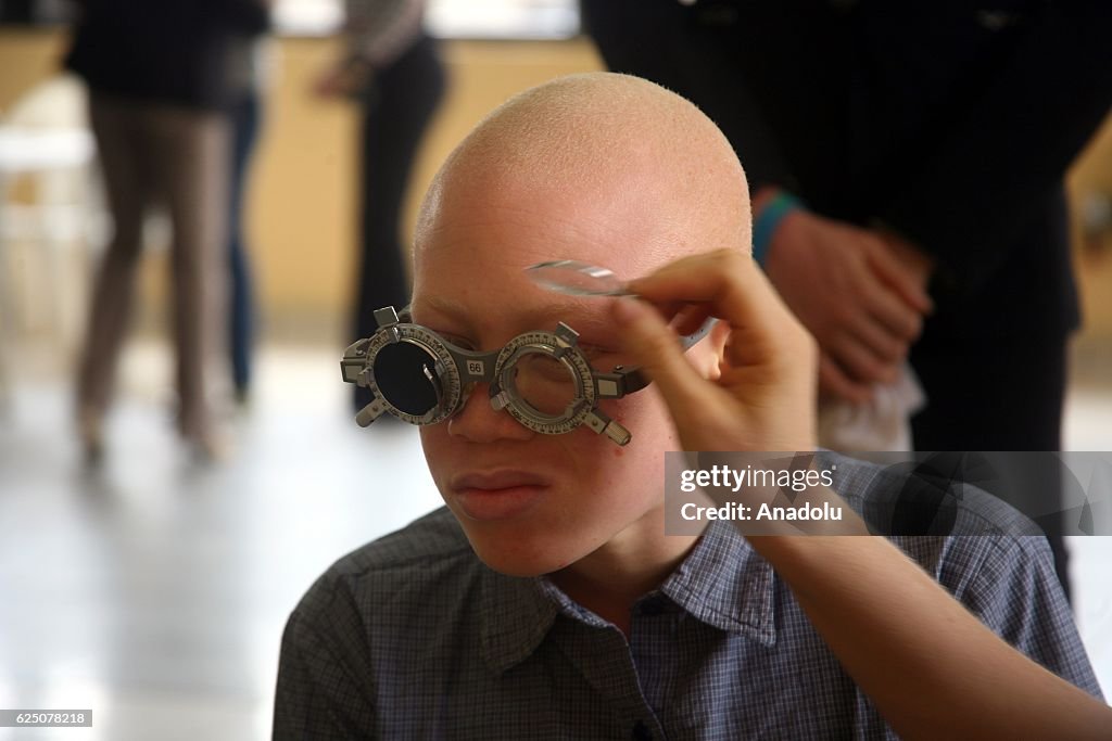 Albinos in Nigeria