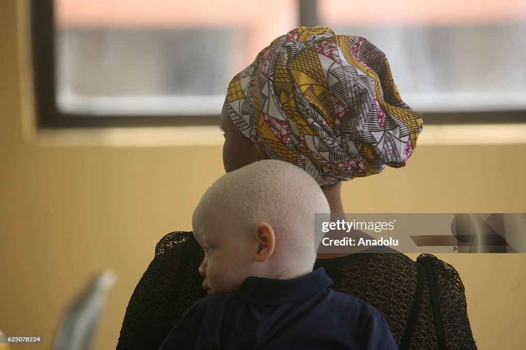 Albinos in Nigeria