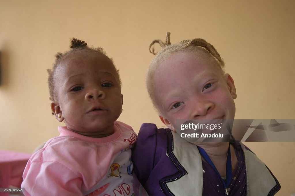 Albinos in Nigeria