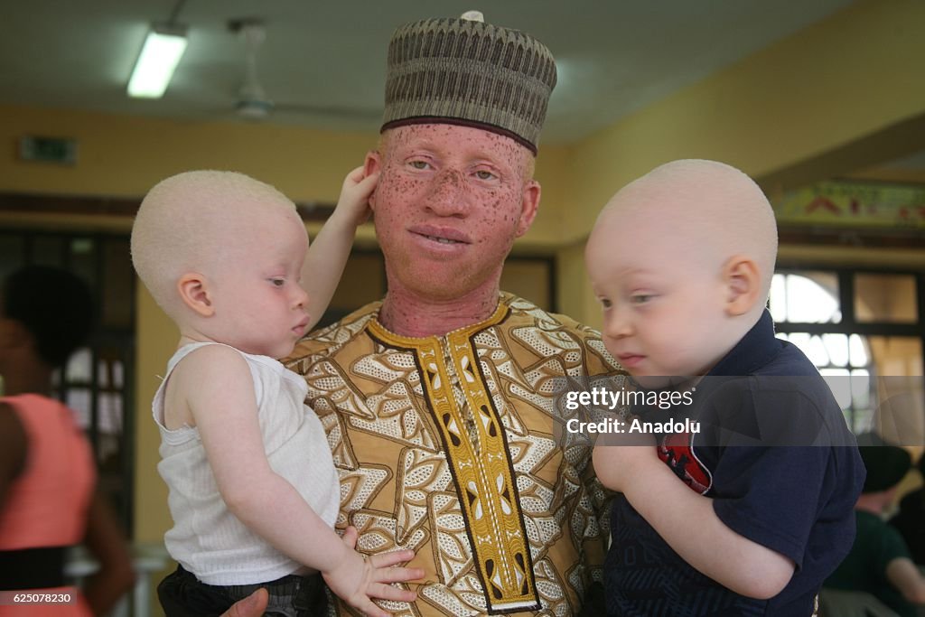 Albinos in Nigeria