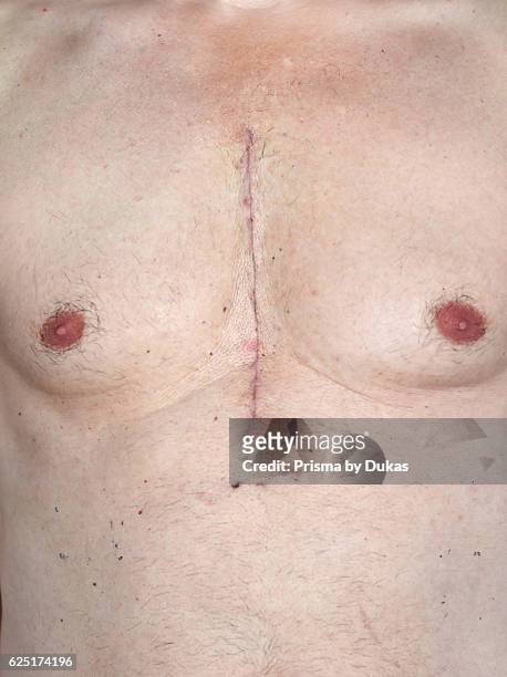 Scar from open heart surgery, where the sternum was cut in two, and the rib cage sprung. Below the scar holes show where the drains and pacemaker...