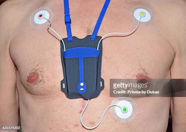 Portable heart monitor , with colour coded electrode pads. Worn by a man who has had open heart surgery, as seen from the scar tissue and tube holes...