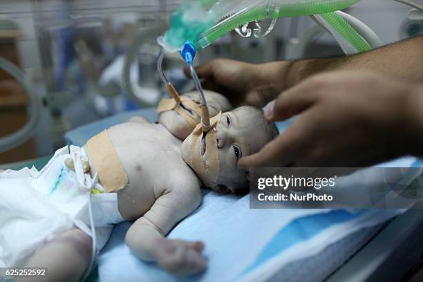 One-day-old Palestinian conjoined twin boys lie in an incubator at the nursery on November 23, 2016 at al-Shifa Hospital in Gaza City.