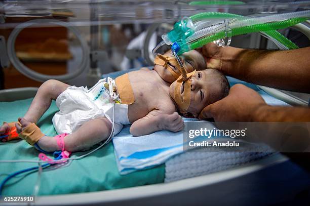 New-born conjoined twin babies are seen in an incubator at Dar Al-Shifa Hospital in Gaza City, Gaza on November 23, 2016.