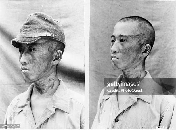 Two side-by-side photos of a man with atomic bomb flash burns on his face, Nagasaki, Japan, October 2, 1945. The man's burns, outlined by his cap,...