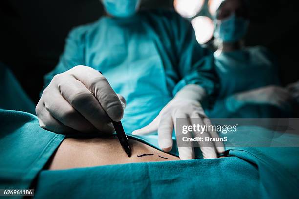 close up of a doctor marking the human skin. - liposuction stock pictures, royalty-free photos & images