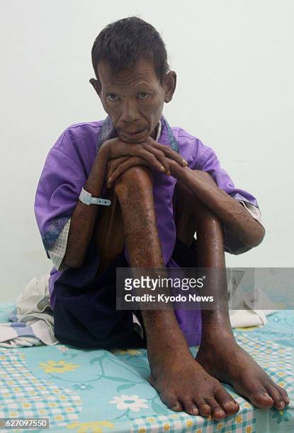 Indonesia - This Nov. 23, 2013 photo shows Sutarip a leprosy patient, sitting on his bed at a leprosy hospital in the village of Sumberglagah in...