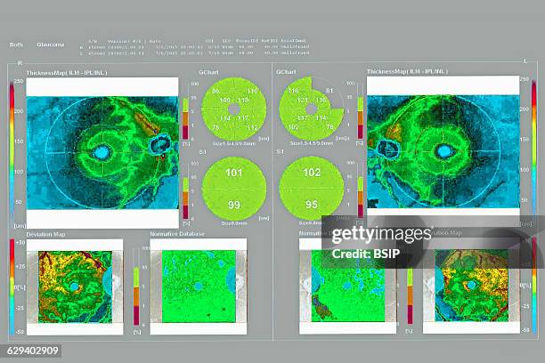 Optival Map 37 Optical Coherence Tomography Oct Stock Photos, High-Res Pictures ...