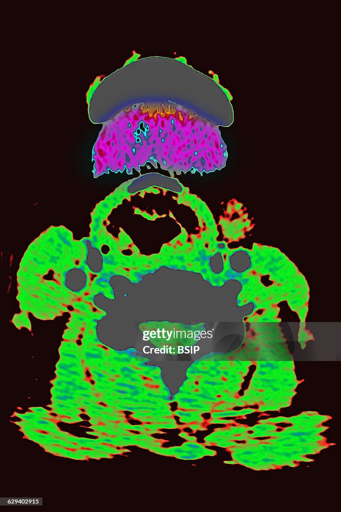 Thyroiditis CT scan