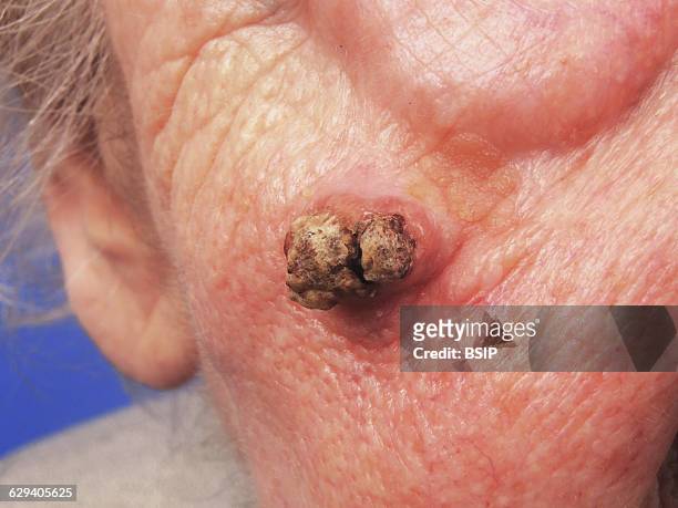Squamous cell carcinoma of the cheek.