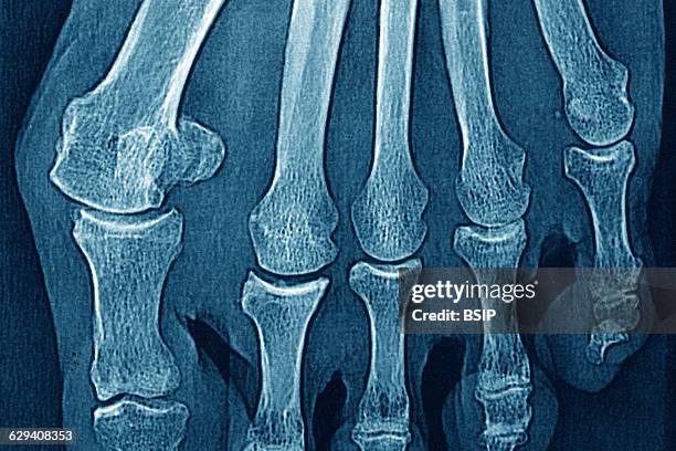 Hallux valgus on the big toe, seen on an x-ray of the right foot.