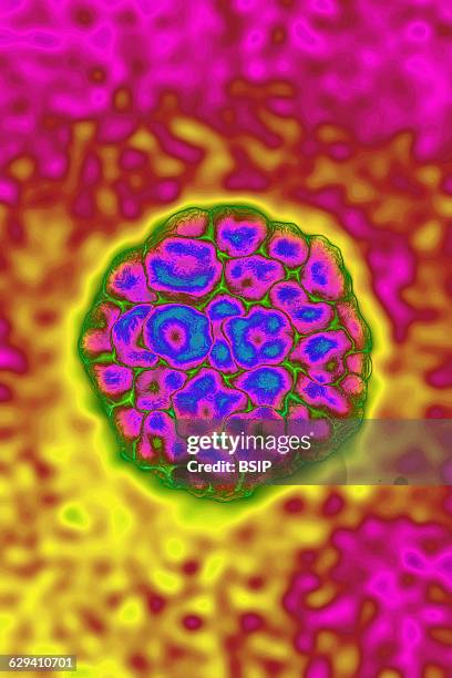 Human Papilloma virus . HPV causes STDs, condyloma acuminata warts that can lead to cervical cancer. It is also the cause of skin infections, warts....