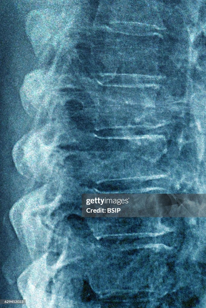 Degenerative disk disease. Severe vertebral osteoarthritis with... News ...