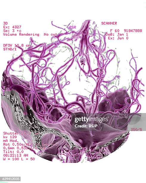 Cerebral atrophy. Parietal cortico-sub-cortical atrophies , seen on a 3D brain CT scan. The cerebral mass is seen shrinking towards its center.