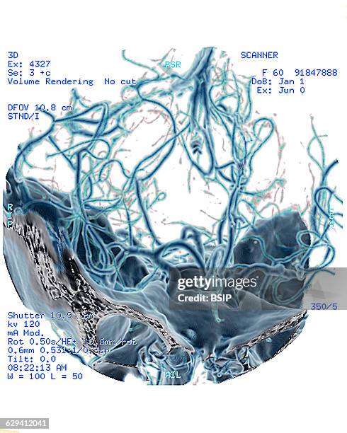 Cerebral atrophy. Parietal cortico-sub-cortical atrophies , seen on a 3D brain CT scan. The cerebral mass is seen shrinking towards its center.