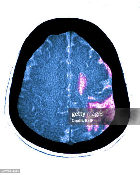 Cerebral atrophy. Parietal cortico-sub-cortical atrophies , seen on a radial cross-section brain CT scan.