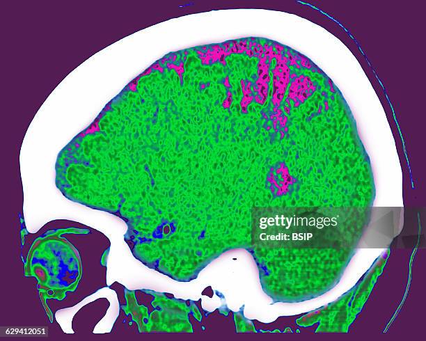 Cerebral atrophy. Parietal cortico-sub-cortical atrophies , seen on a sagittal plane cross-section brain CT scan.