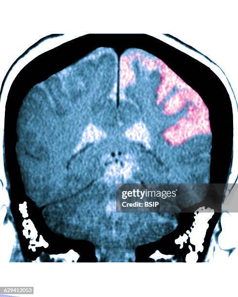 Cerebral atrophy. Parietal cortico-sub-cortical atrophies , seen on a frontal cross-section brain CT scan.