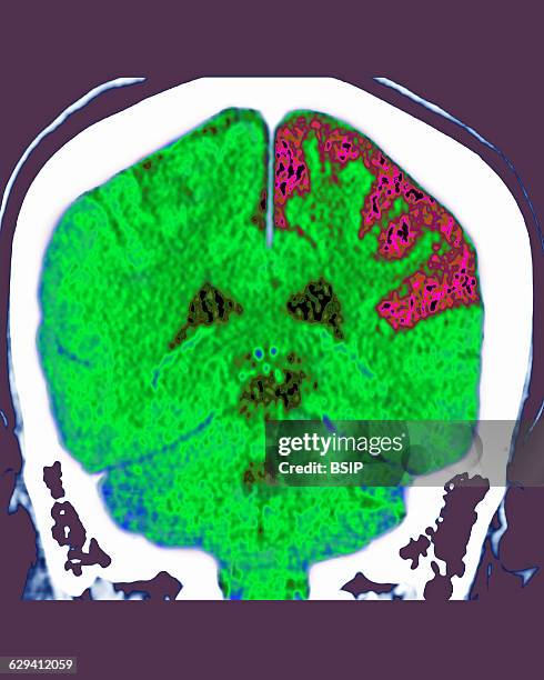Cerebral atrophy. Parietal cortico-sub-cortical atrophies , seen on a frontal cross-section brain CT scan.