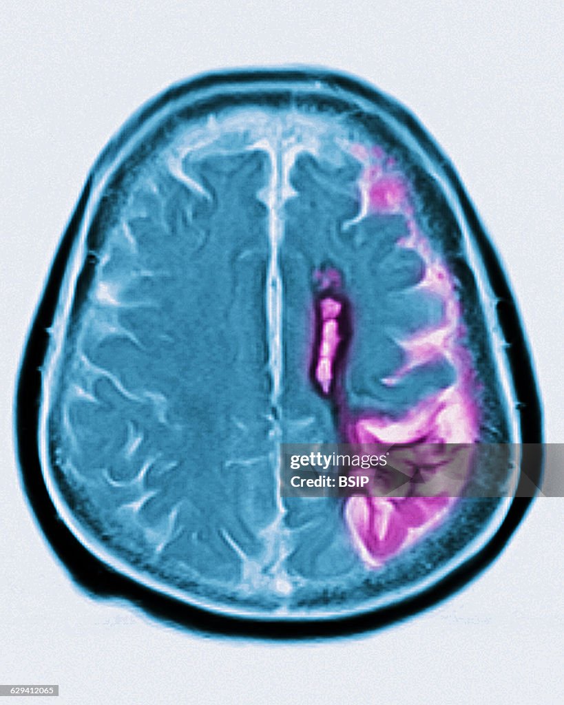 Cerebral atrophy, mri