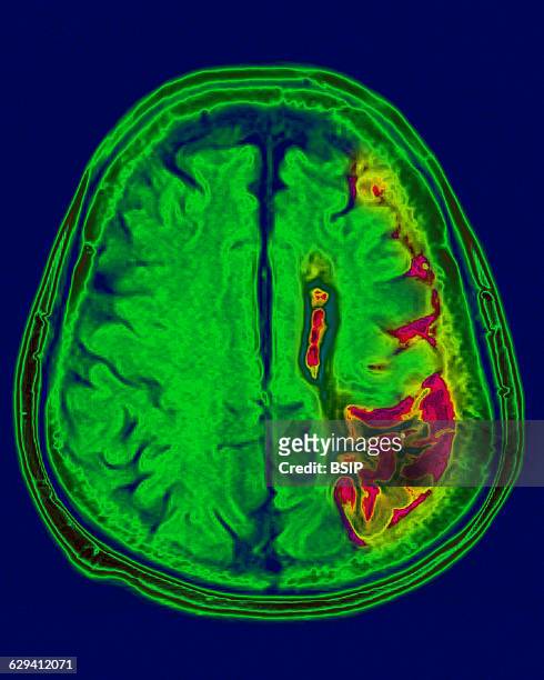 Cerebral atrophy. Parietal cortico-sub-cortical atrophies , seen on a radial cross-section brain MRI scan.