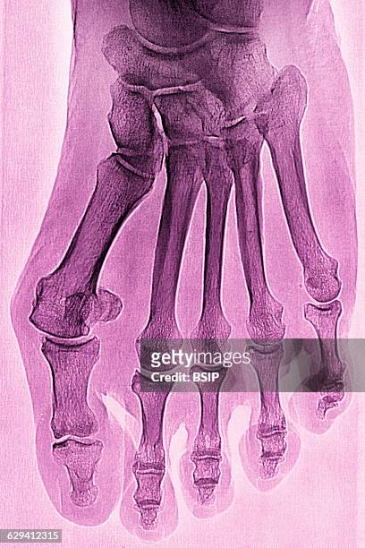 Hallux valgus on the big toe, seen on an x-ray of the right foot.