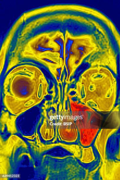 Mri Scan Sinus Machine 148 Maxillary Sinuses Stock Photos, High-Res Pictures, and Images ...