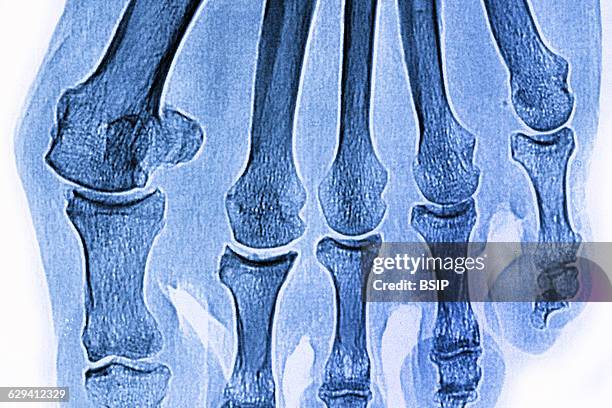 Hallux valgus on the big toe, seen on an x-ray of the right foot.