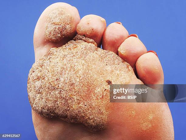 Plantar warts.